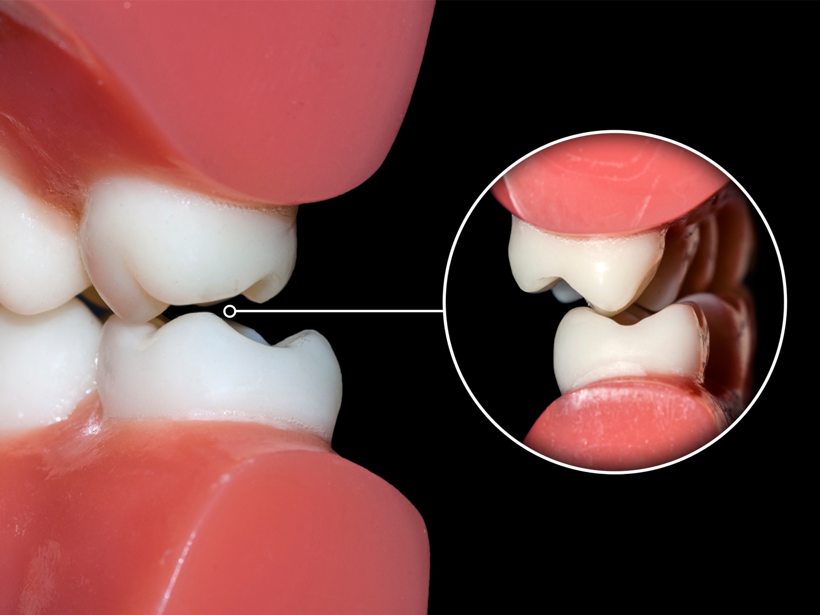 What is Dental Occlusion?
