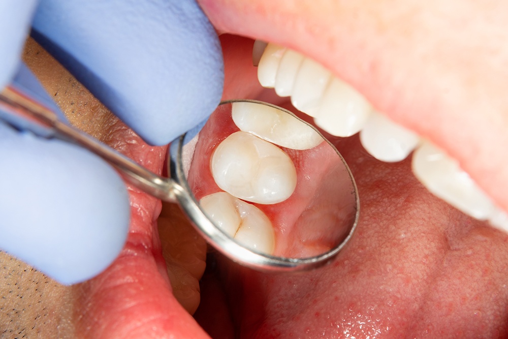 Why should you go for Dental Sealants?
