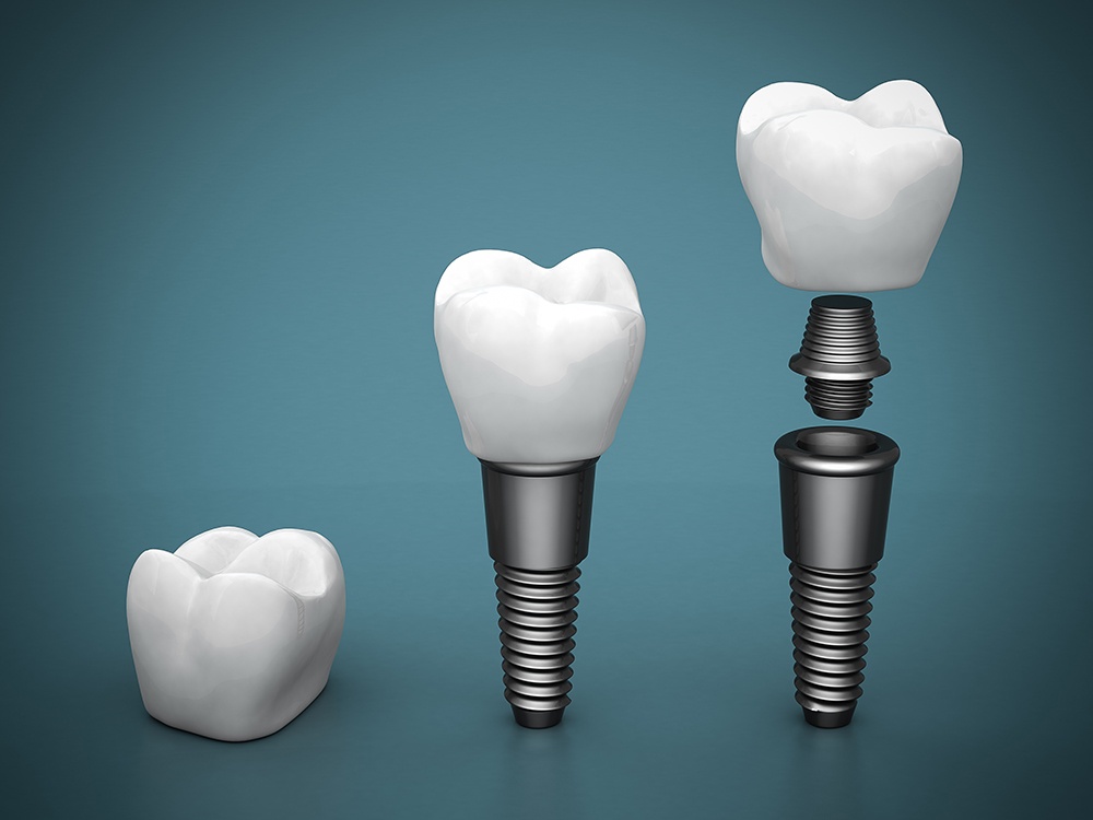 Say ‘YES’ to Dental Implants
