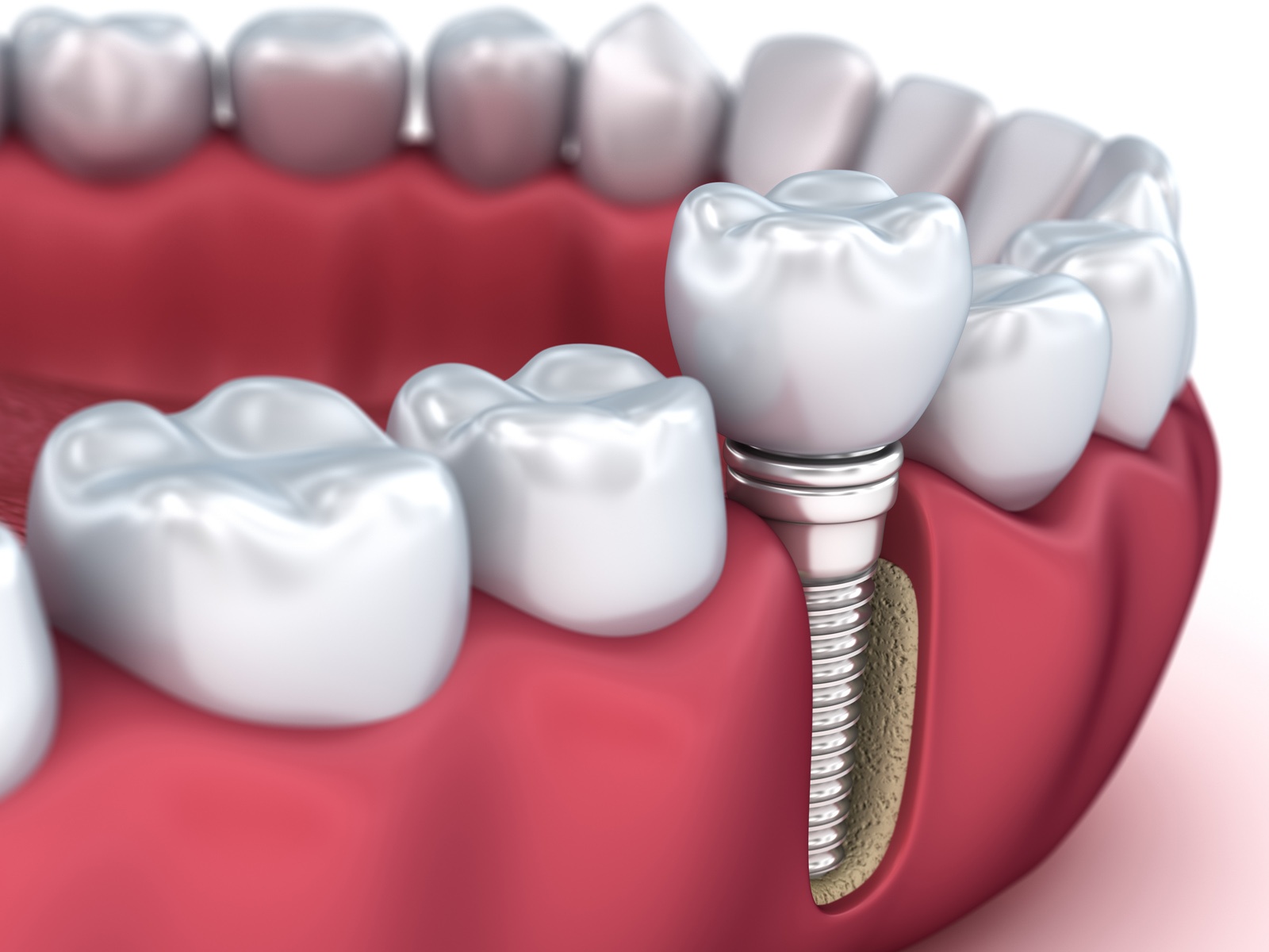 How to Replace Damaged Teeth with Dental Implants