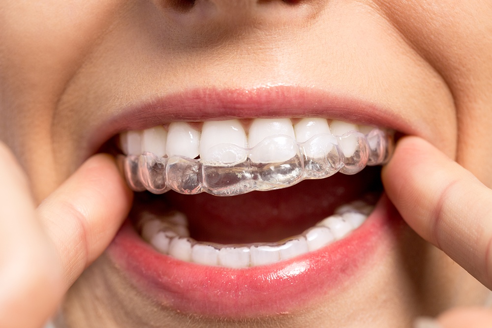 Invisalign: Secret to a Flawless Smile