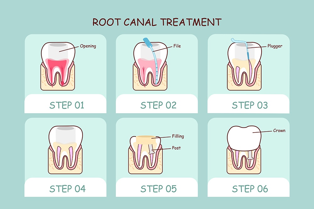 How Root Canal Works for Your Teeth