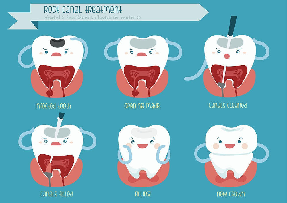 Things you need to know: Root Canals