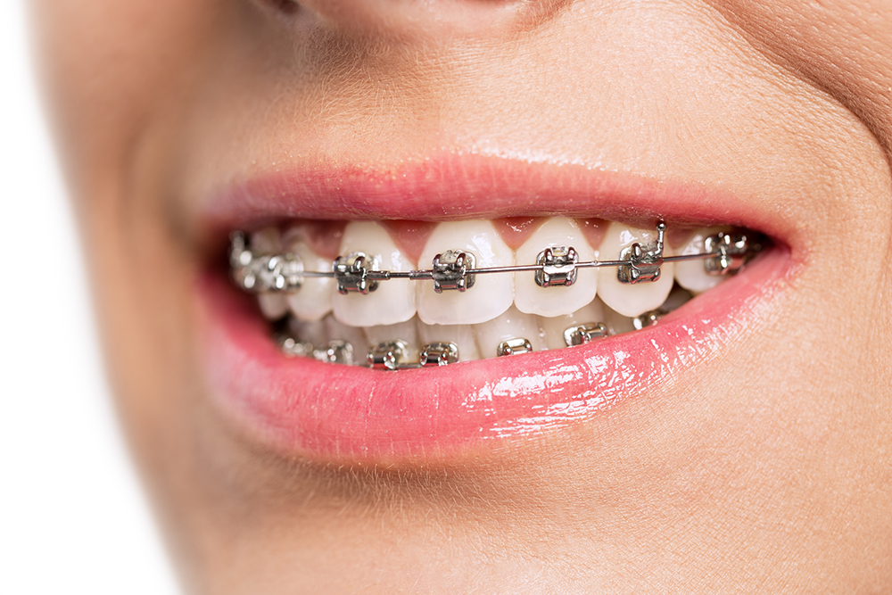 Braces for kids: Are They Right?