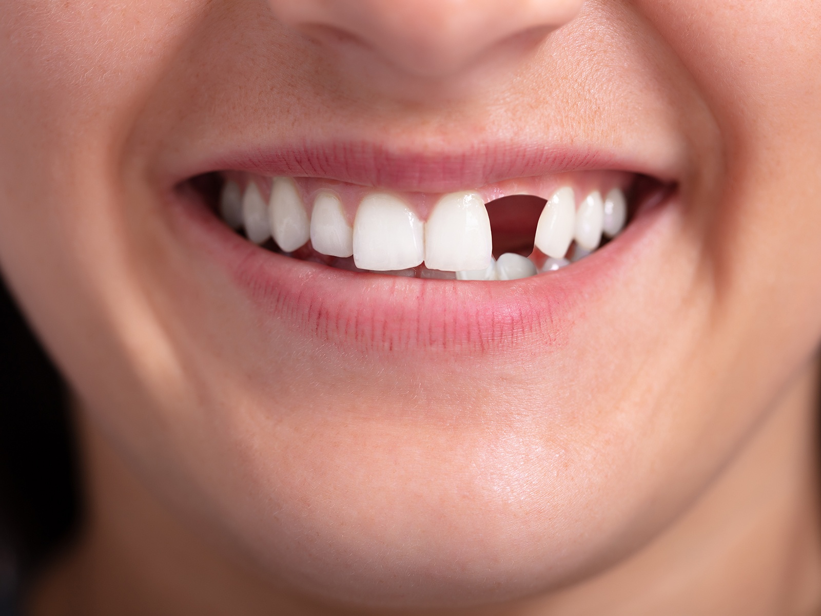 All About Avulsed Tooth Treatment And Management