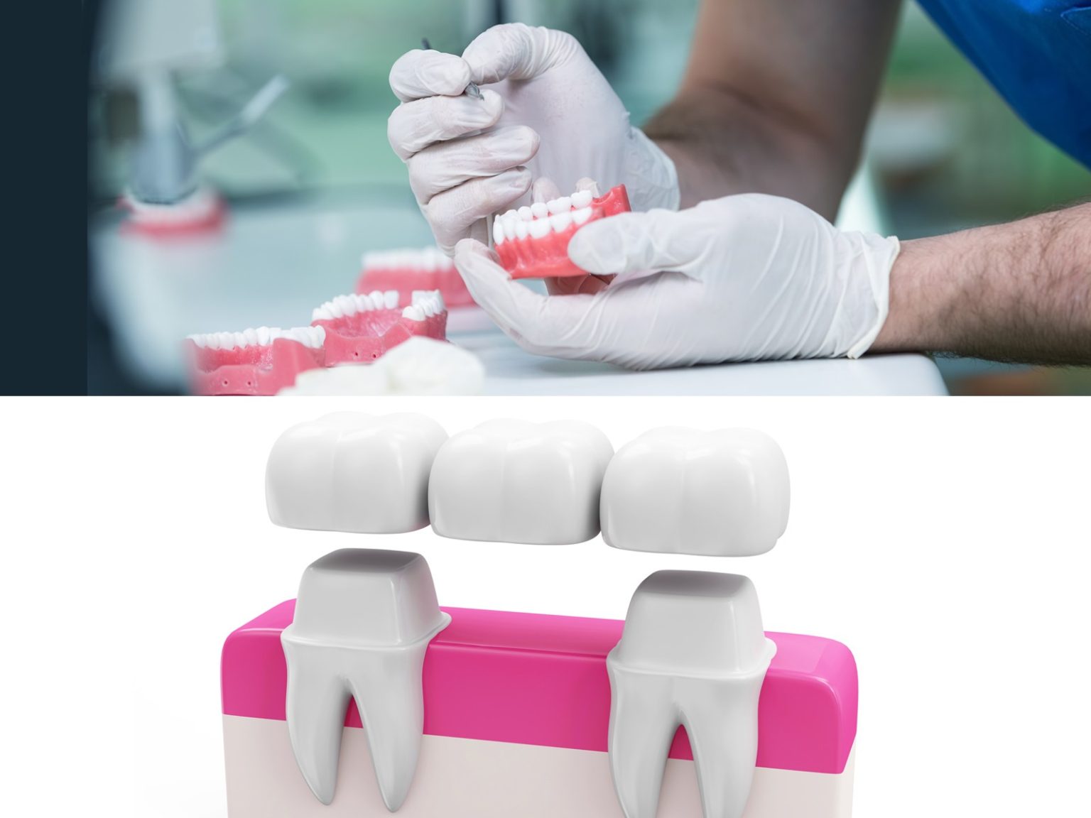 What’s The Difference Between Dentures and Bridges?