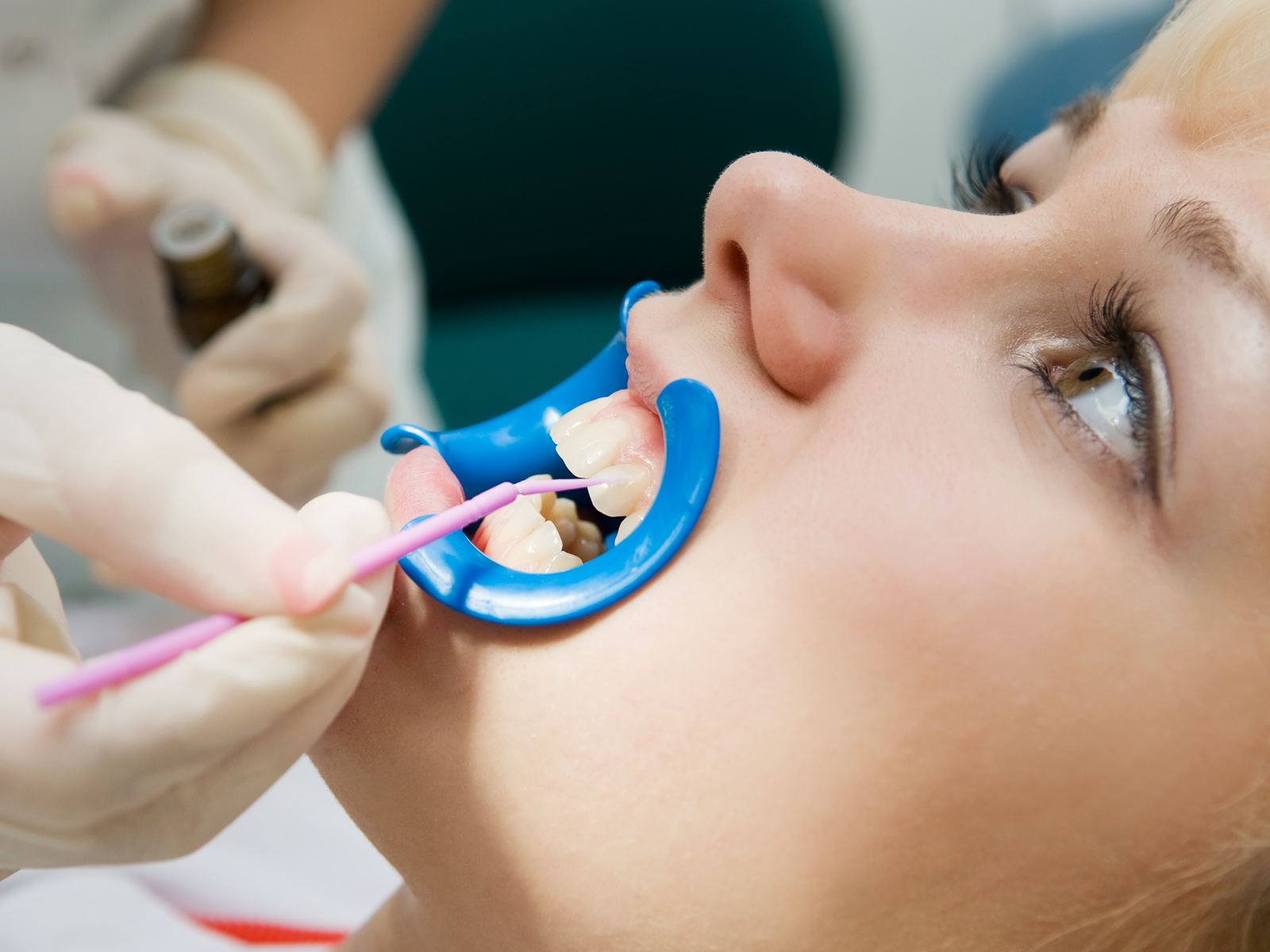 Can topical fluoride treatment protect your child from tooth decay?