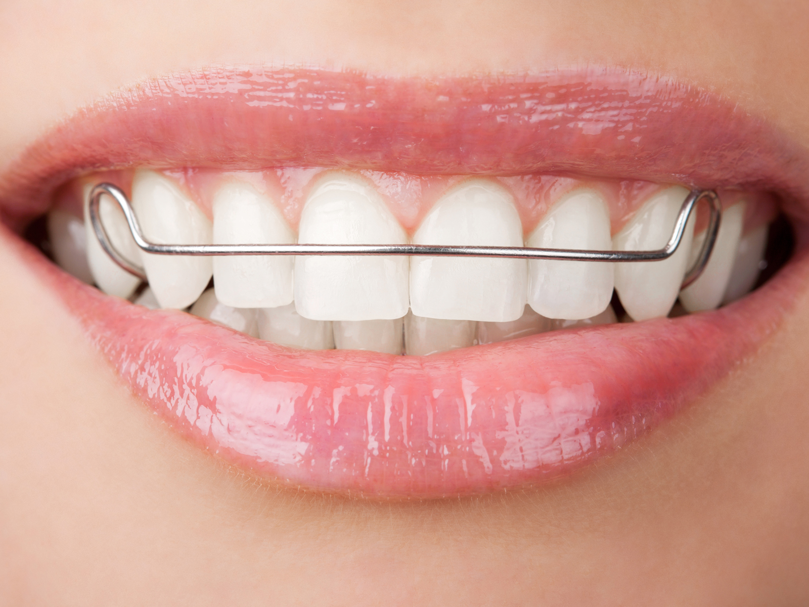 Kinds of Orthodontic Retainers That Can Protect Your New Smile