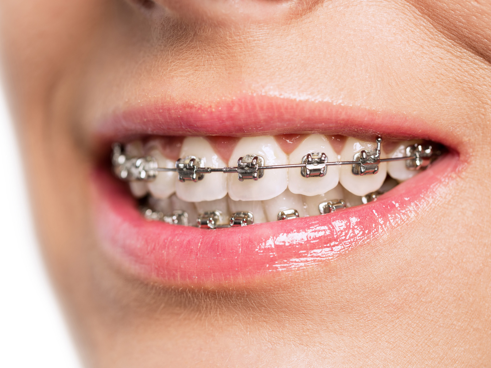 How to Avoid Dental Diseases While Wearing Braces