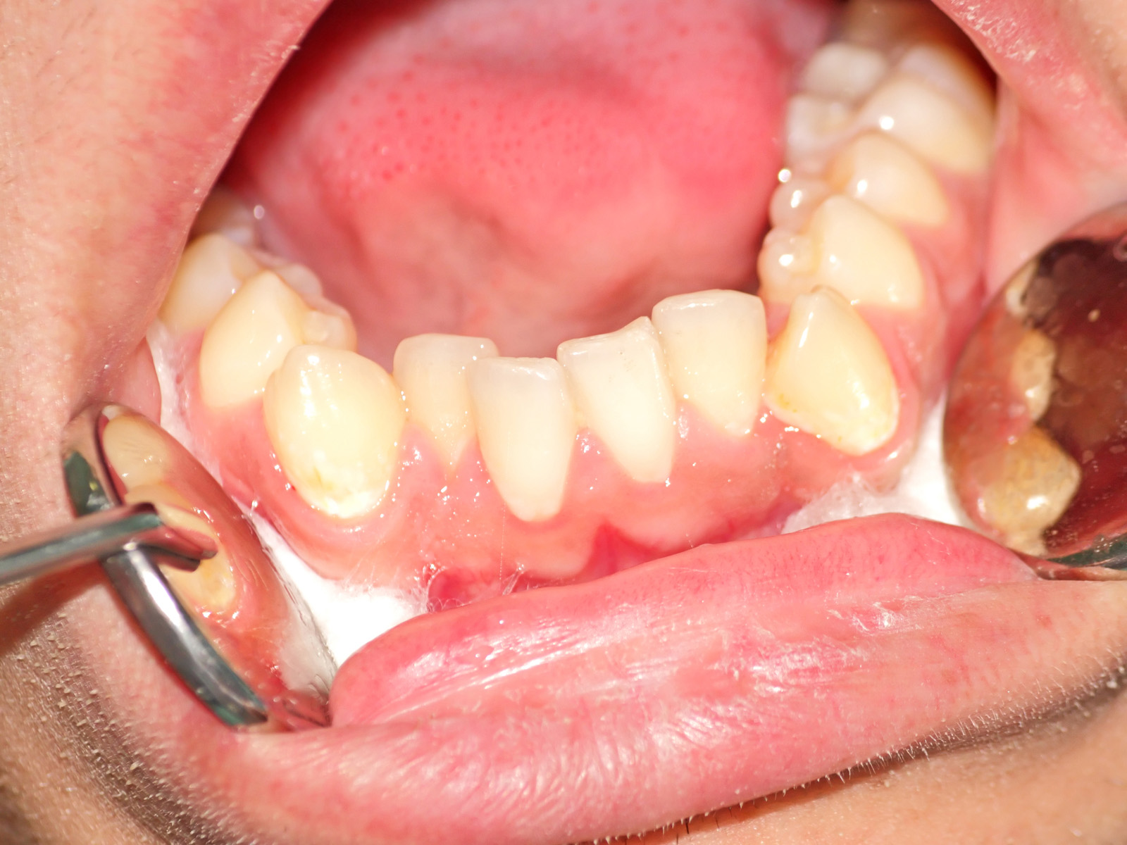 Correcting a Poor Bite Improves Dental Health as Well as Smile Appearance