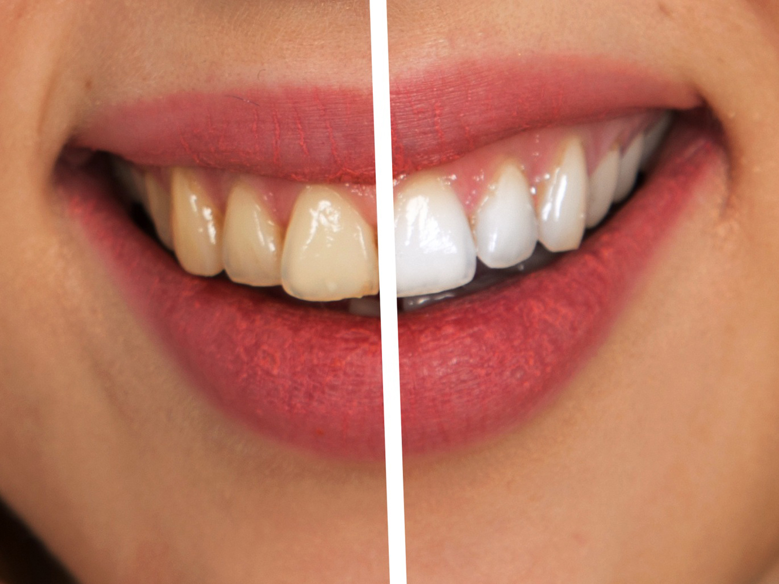 Does hydrogen peroxide whiten teeth?