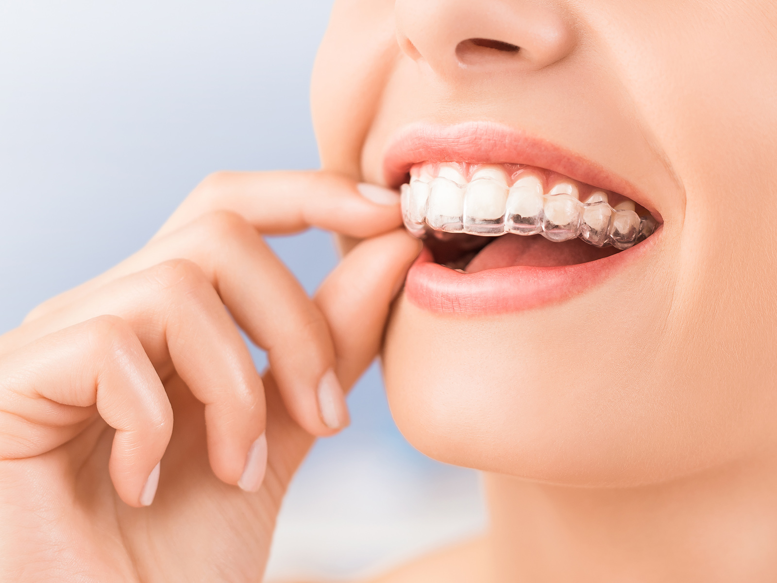 How Invisalign Changes Your Face?