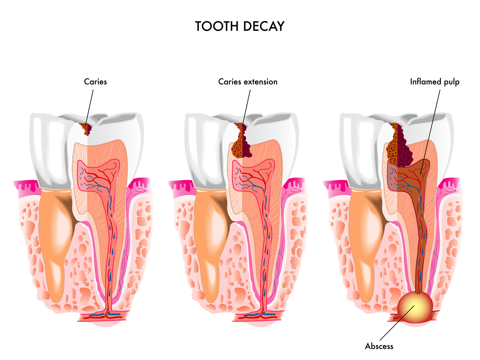 What are Dental Caries