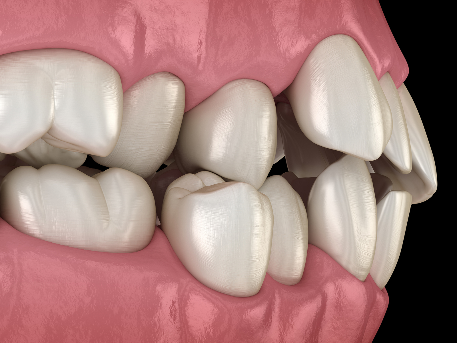 How to fix misaligned teeth?