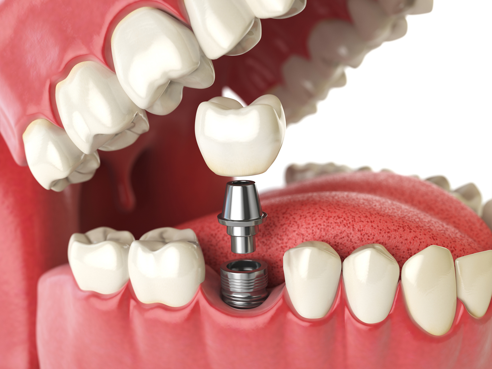 Is there a cheaper alternative to dental implants?