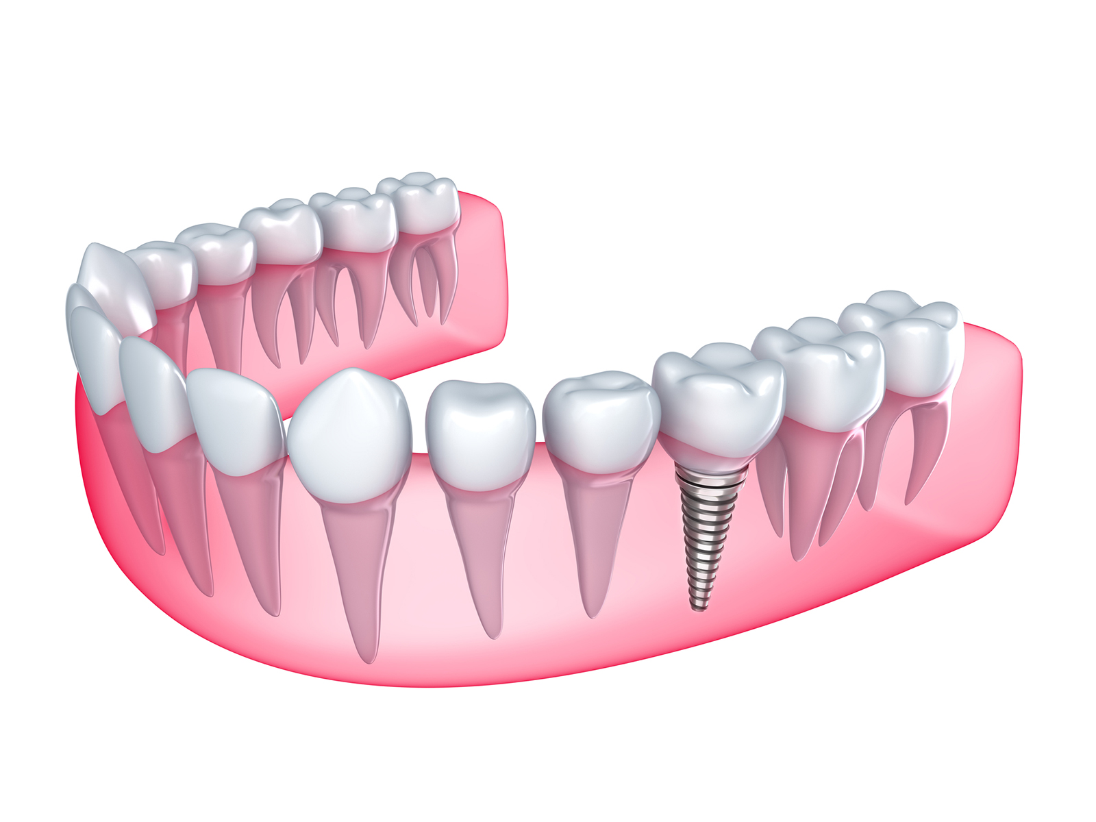 Does Medicare pay for implants?