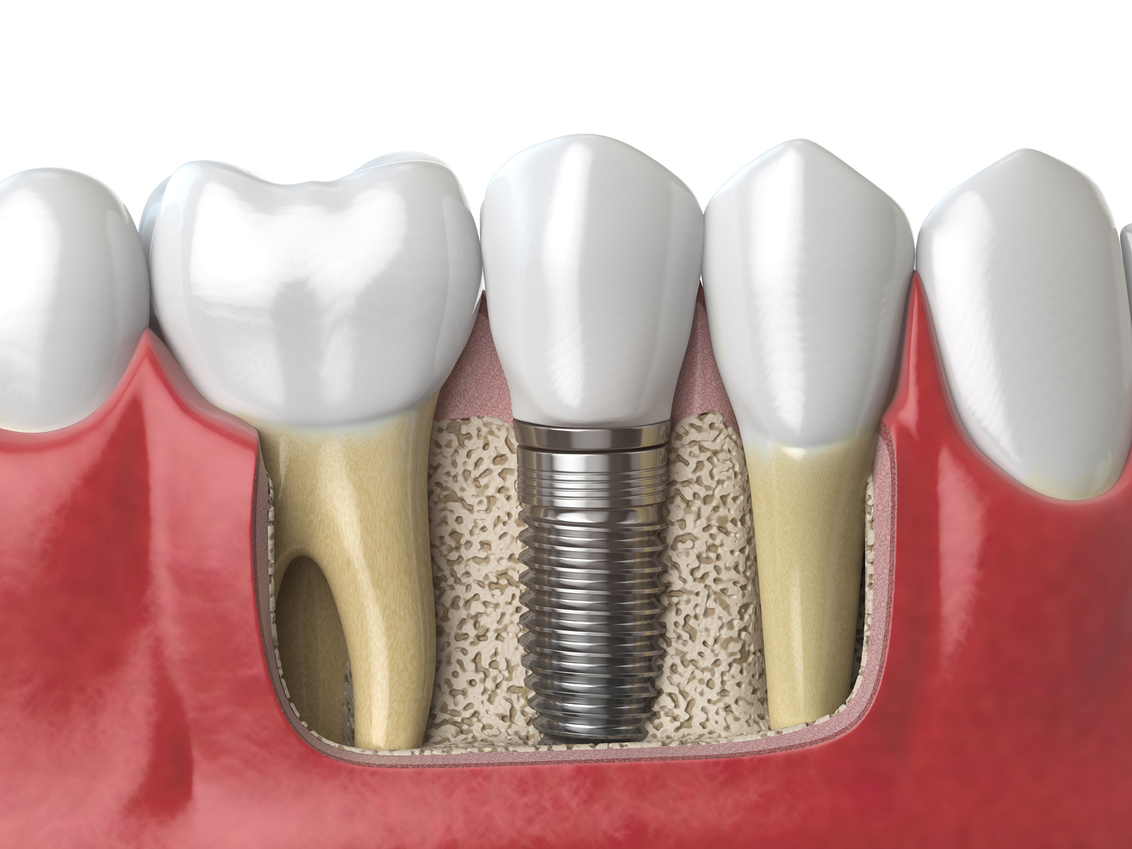 What Is The Age Limit For Dental Implants?