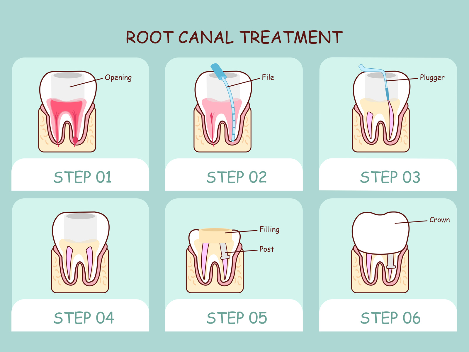 How long does root canal treatment last?