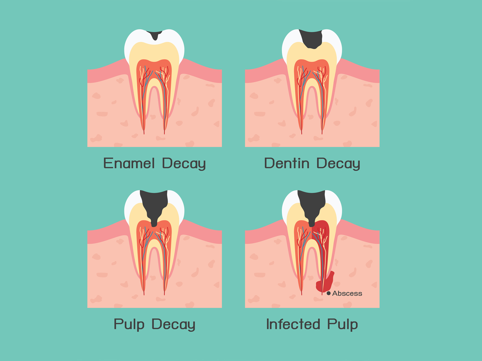 How to prevent tooth decay?