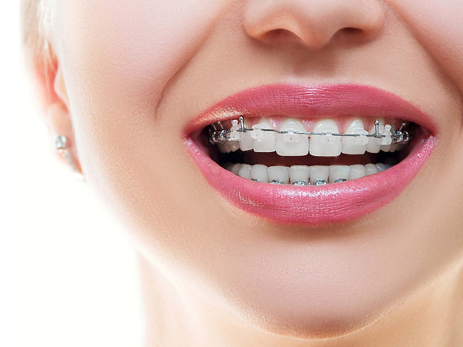 How Often should braces wire be changed?