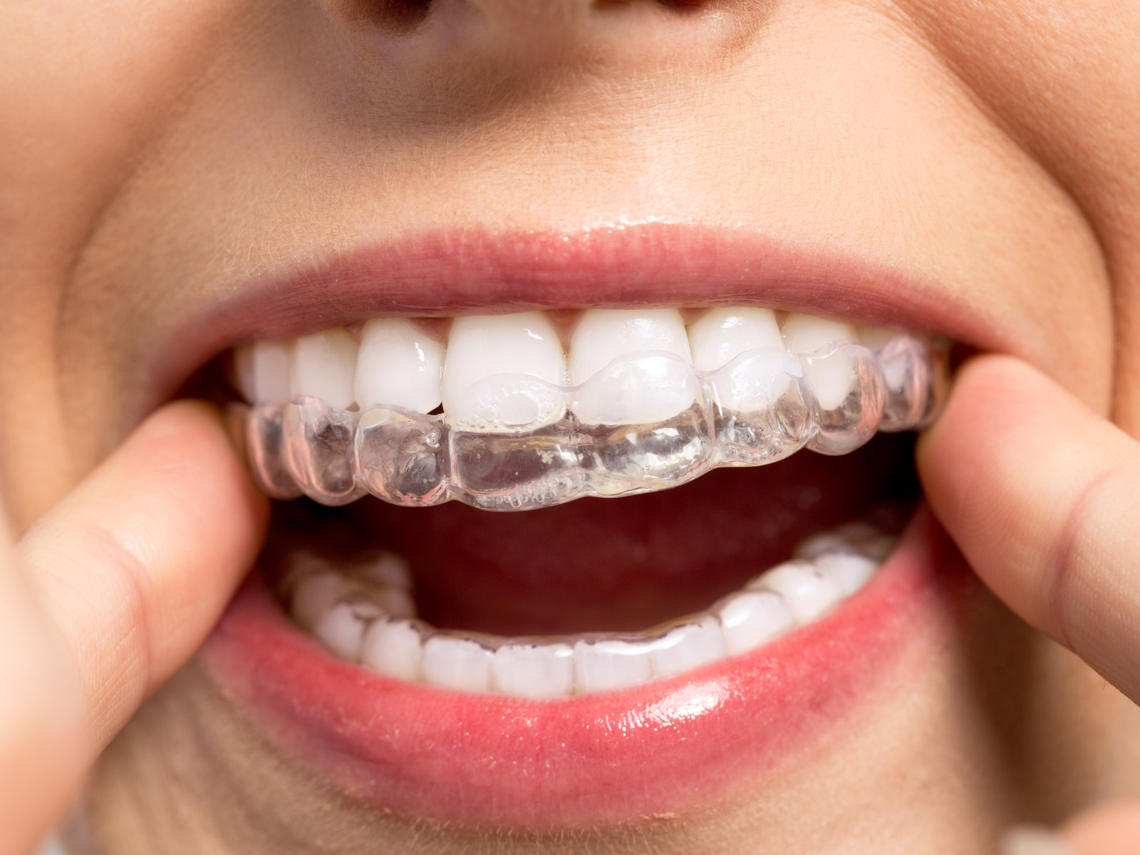Can Invisalign damage teeth?