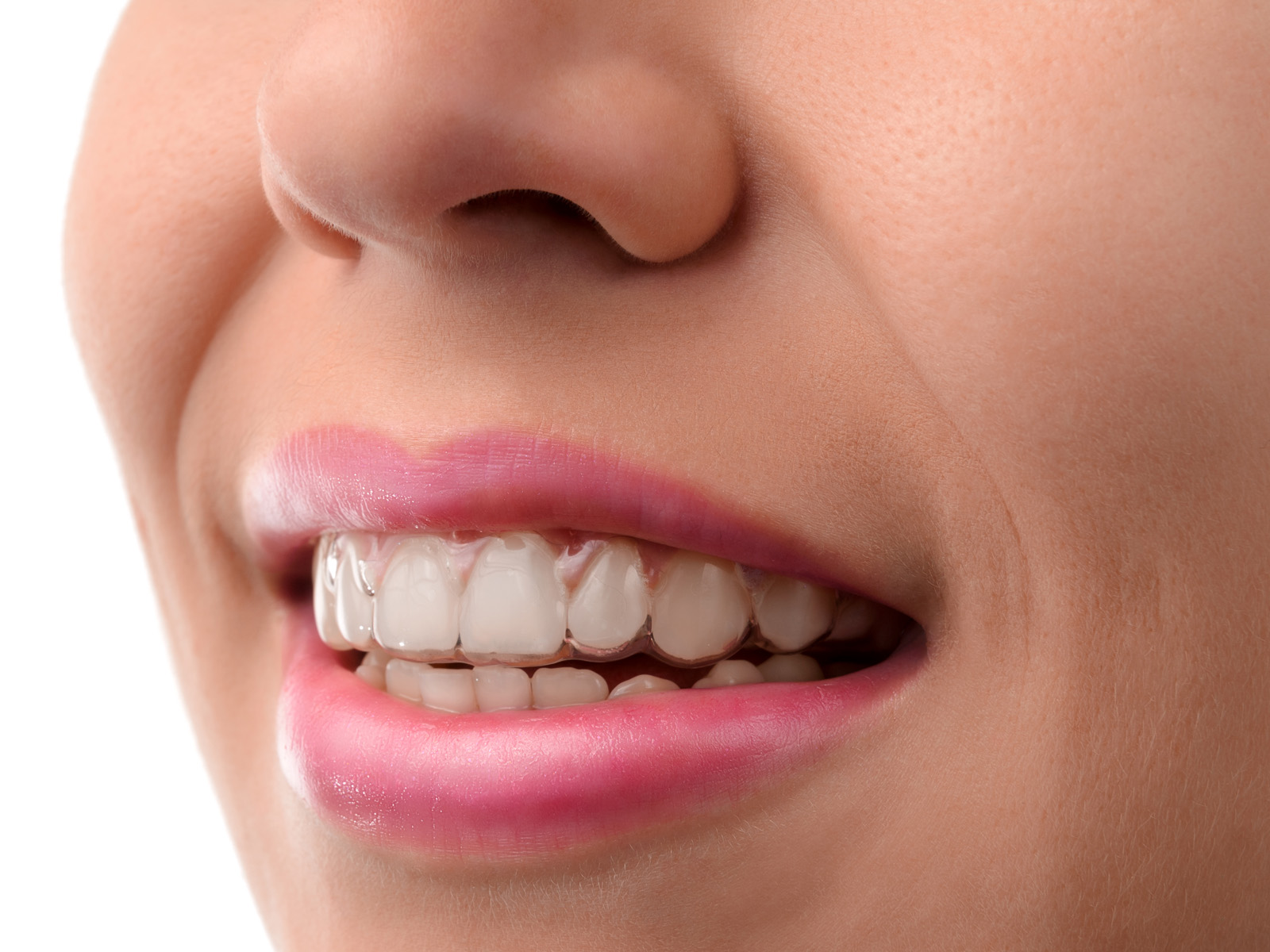 Does Invisalign make your teeth yellow?