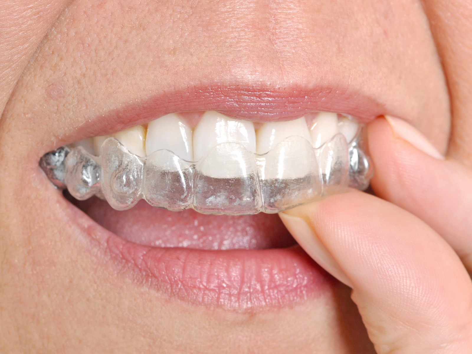 What is the success rate of Invisalign?