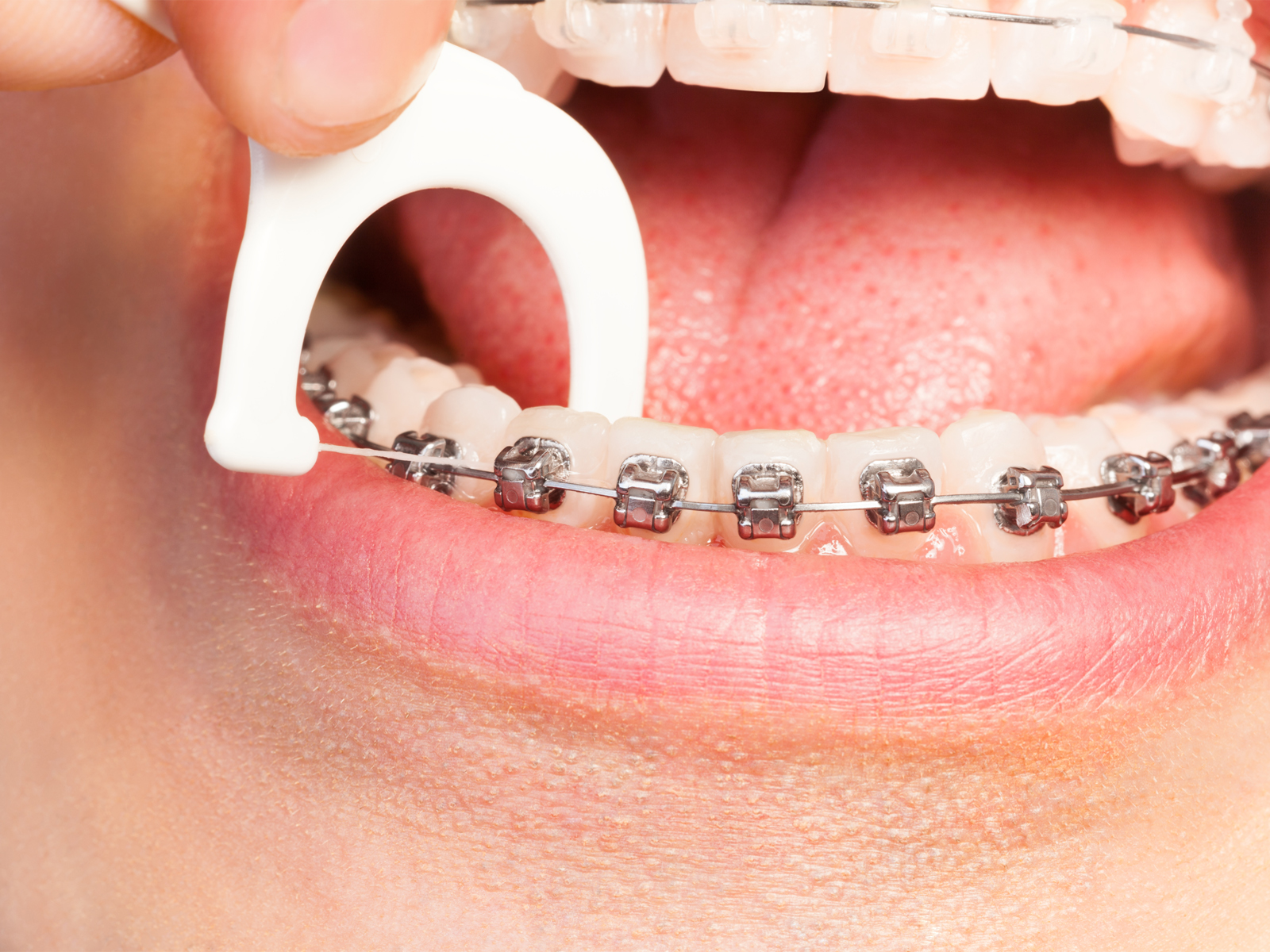 How often should braces be cleaned?