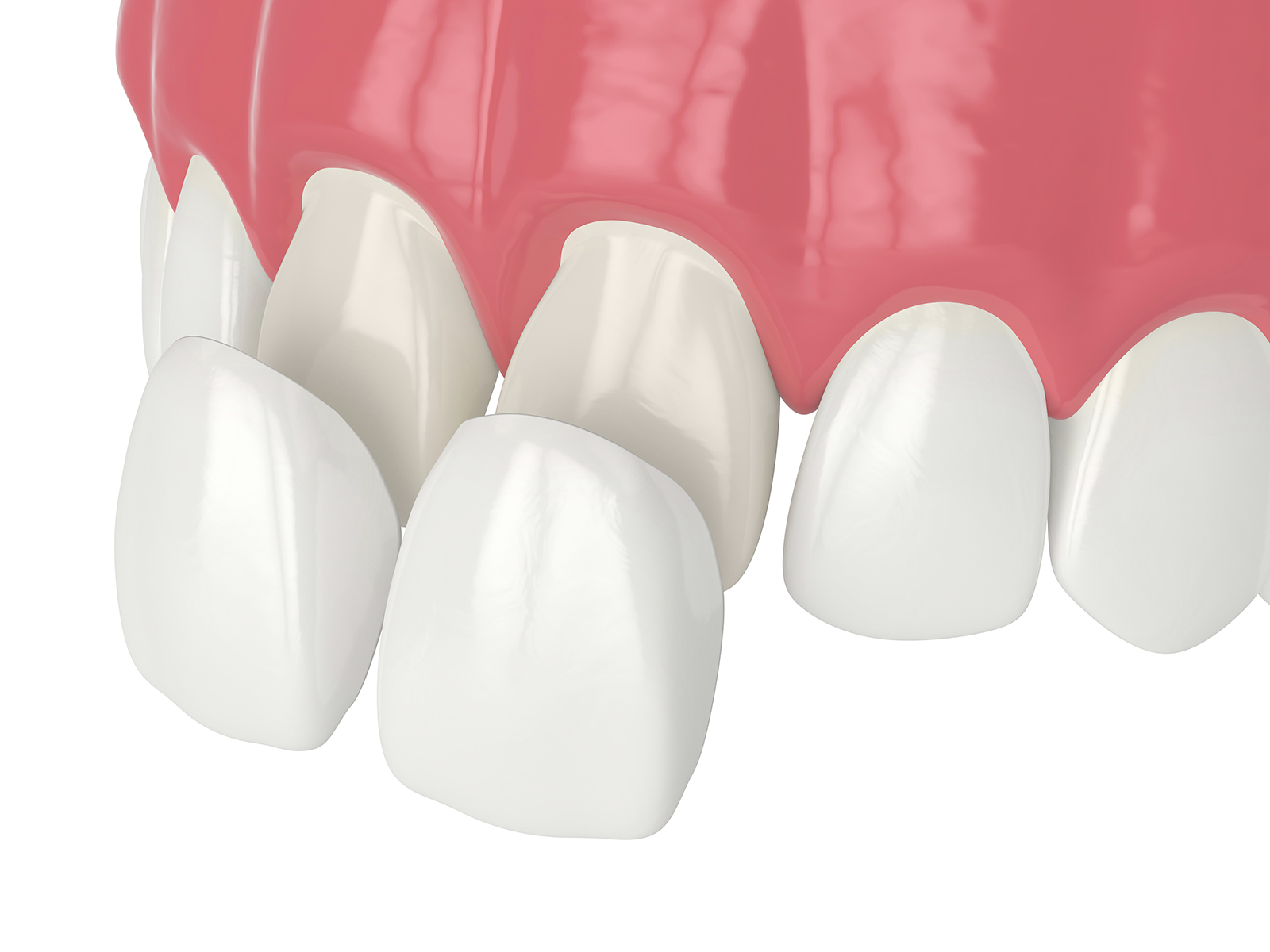5 Benefits Of Dental Veneers