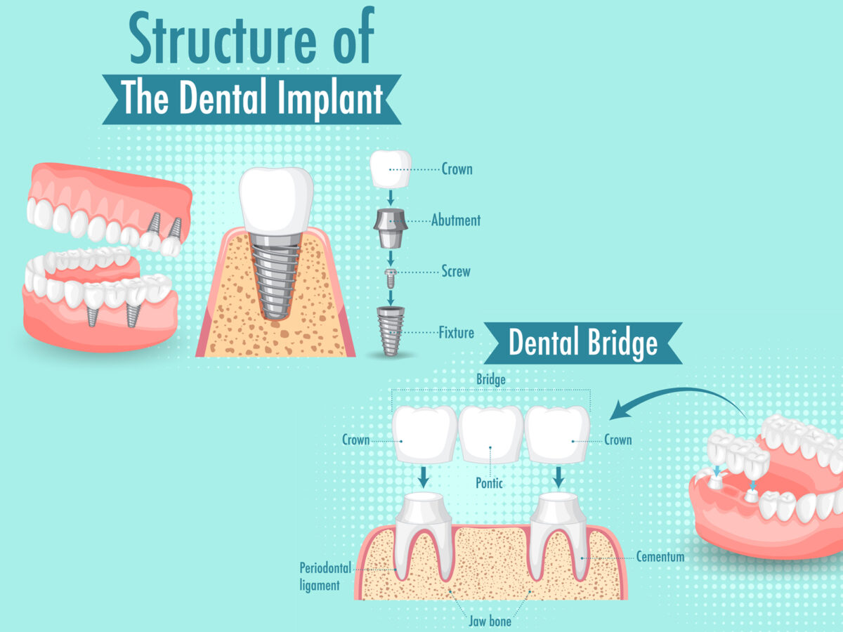 What is the cost difference between dental bridges and implants?