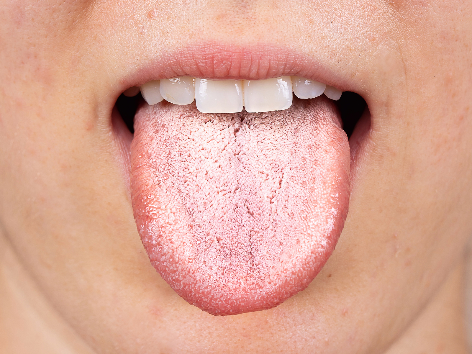 What is oral psoriasis? Symptoms, Causes, and Treatment