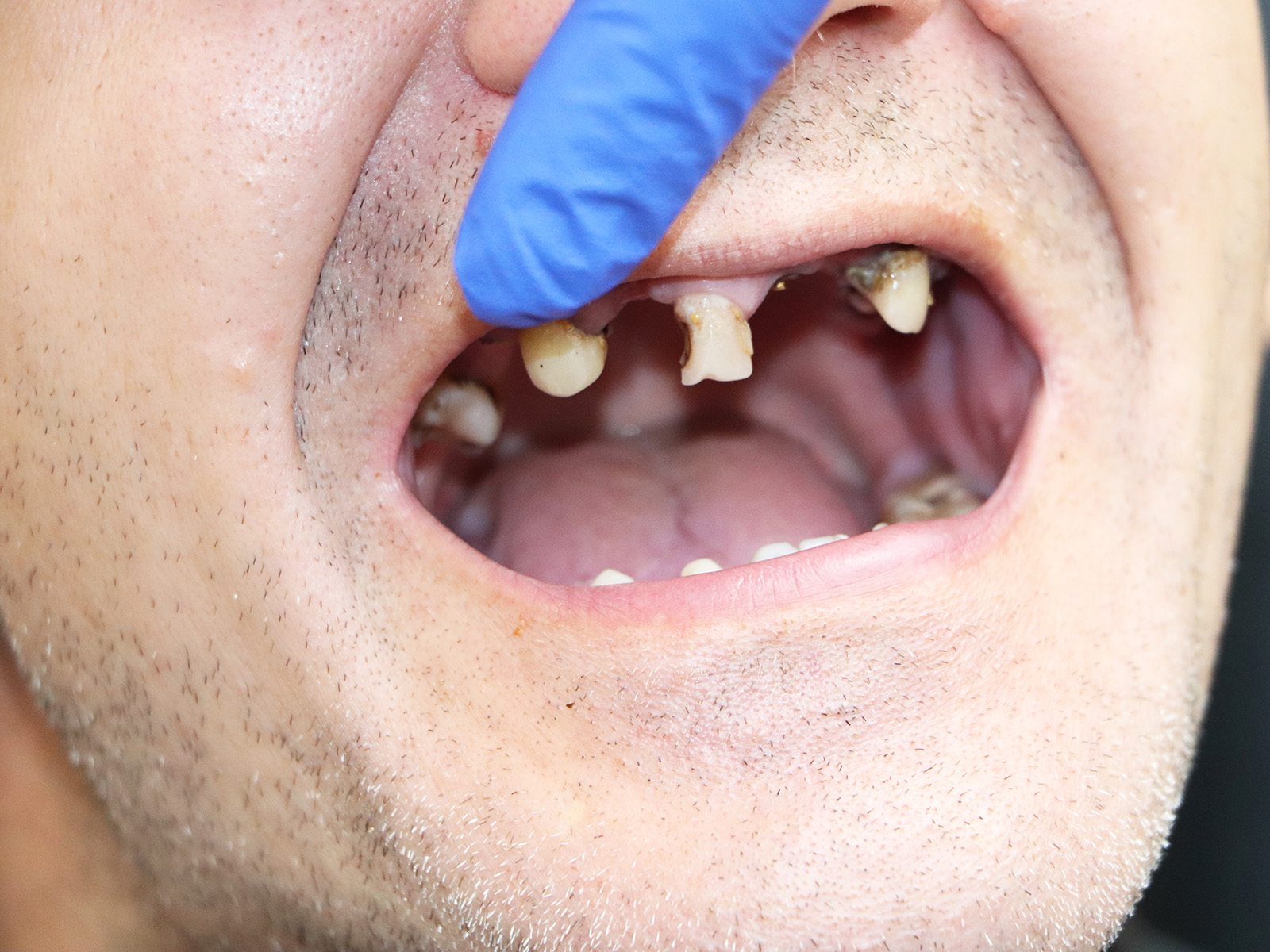 Tips For Proper Denture Storage