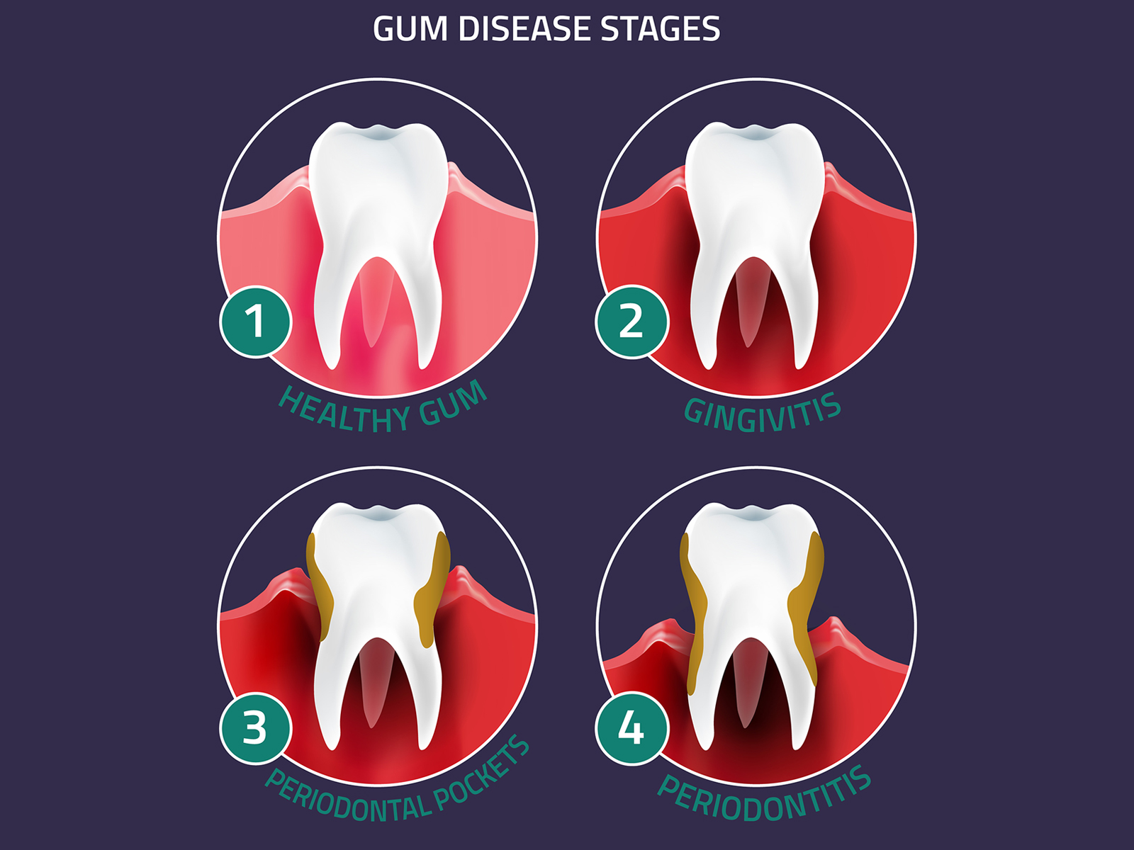 Understanding The Stages of Gum Disease