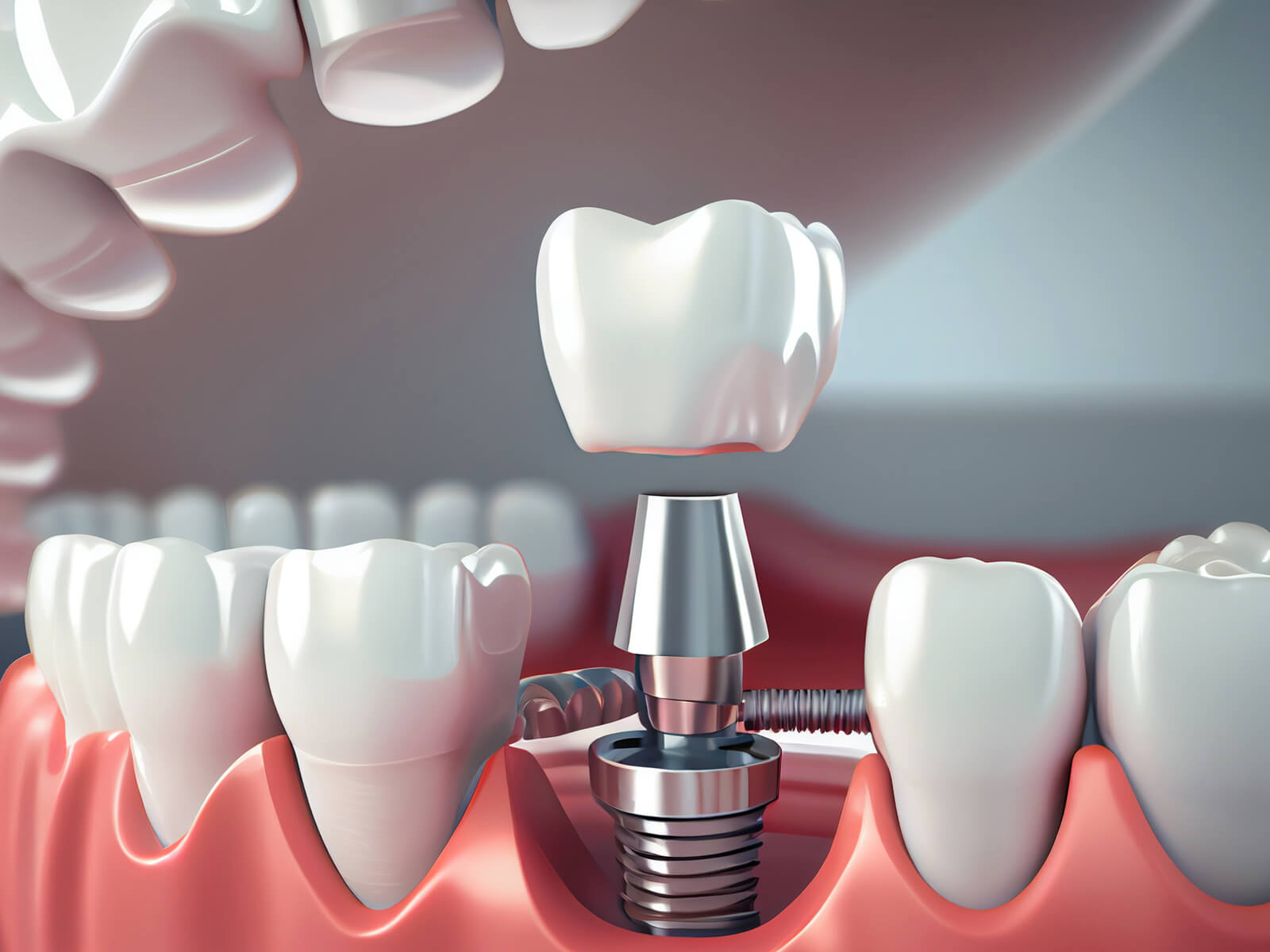 Types Of Crowns For Root Canal-Treated Teeth