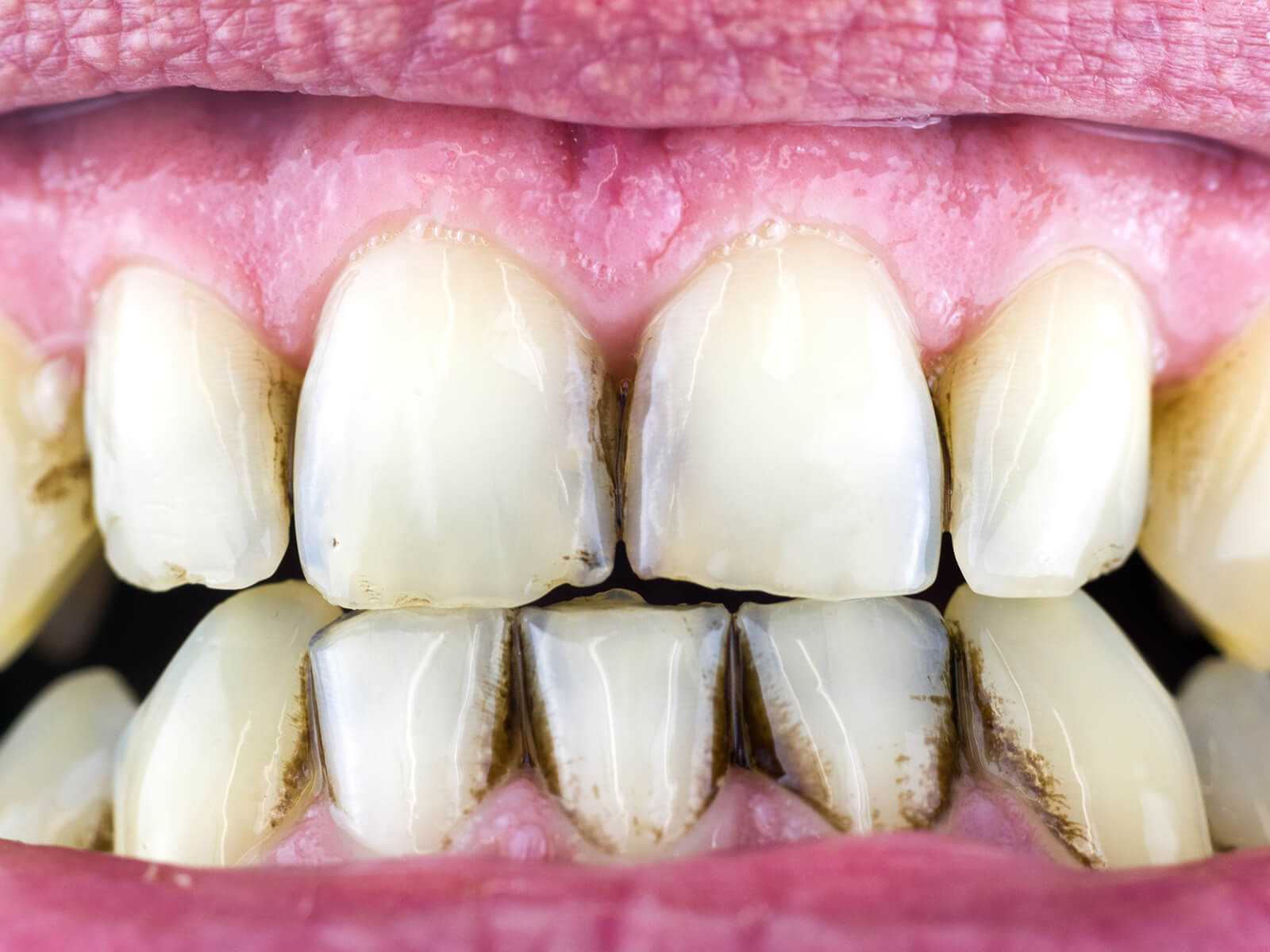 Unraveling the Mystery of Black Tartar on Teeth: Causes, Symptoms, and Prevention