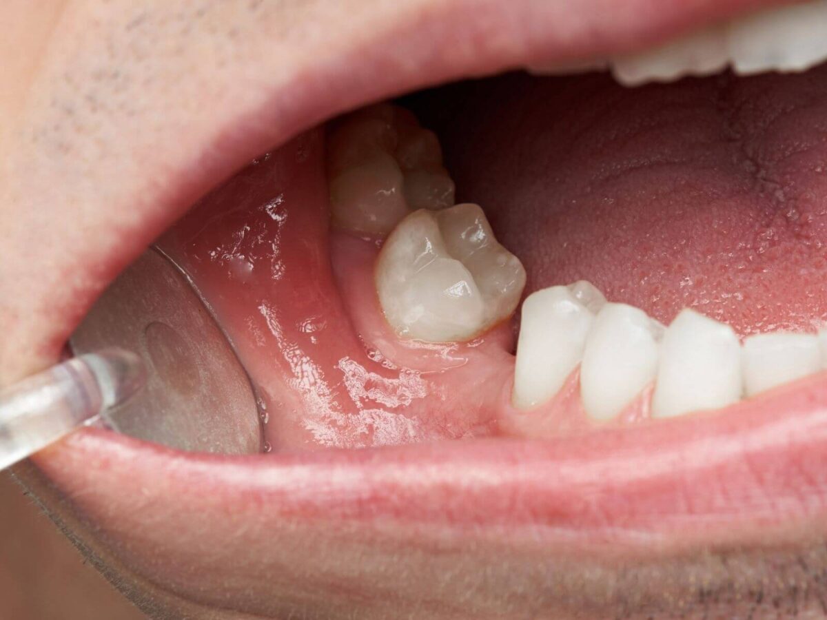 How To Handle A Loose Adult Tooth