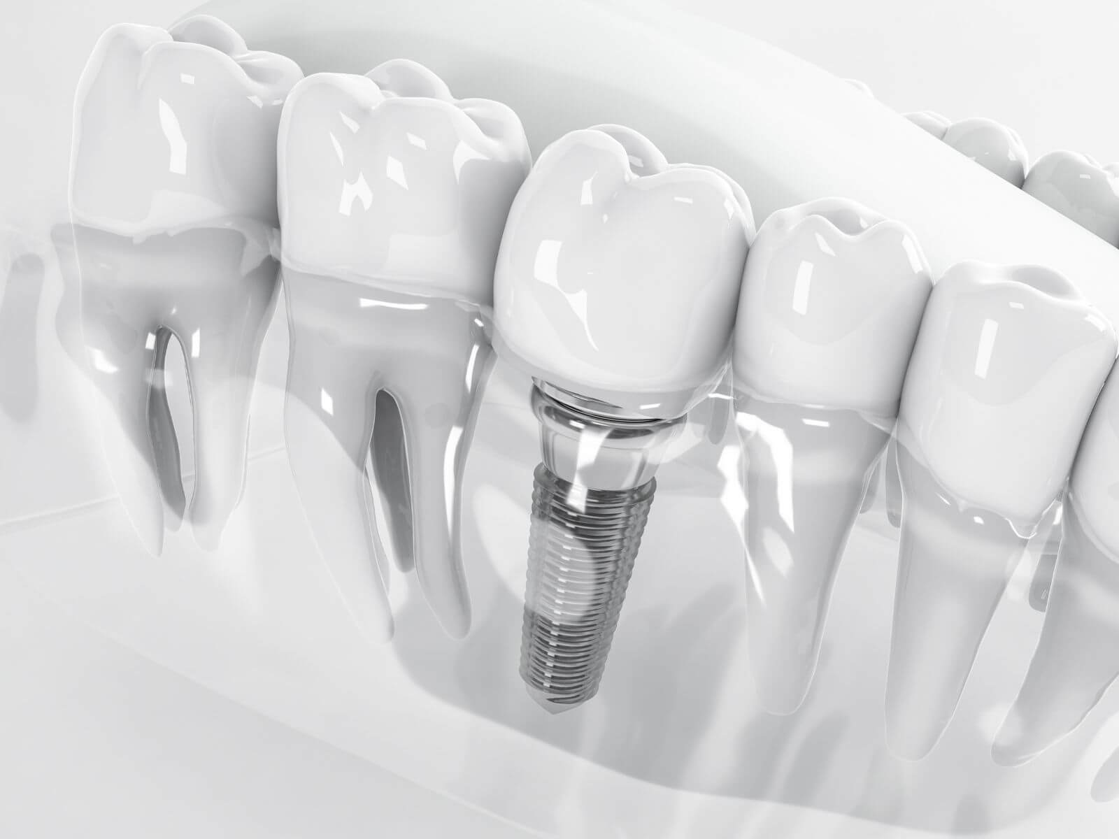 Why All-on-4 Dental Implants Is So Effective