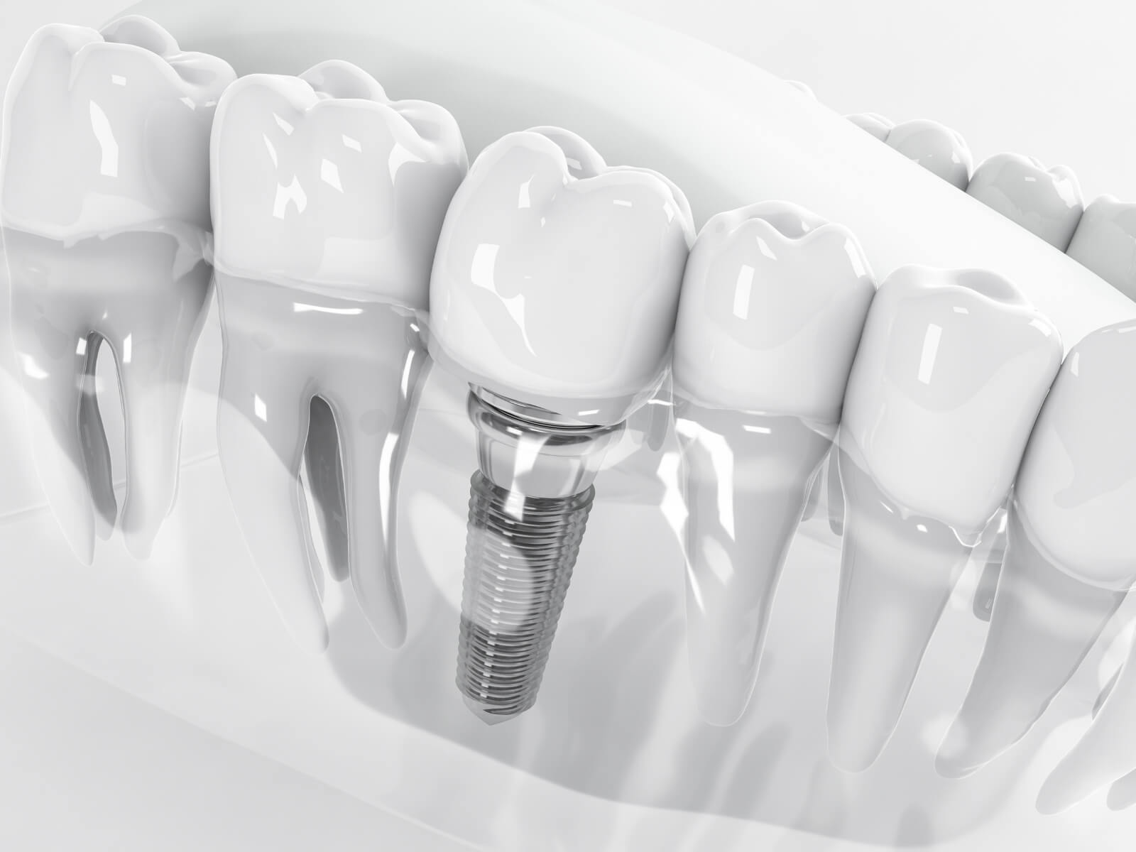 5 Ways To Care For Your Dental Implants