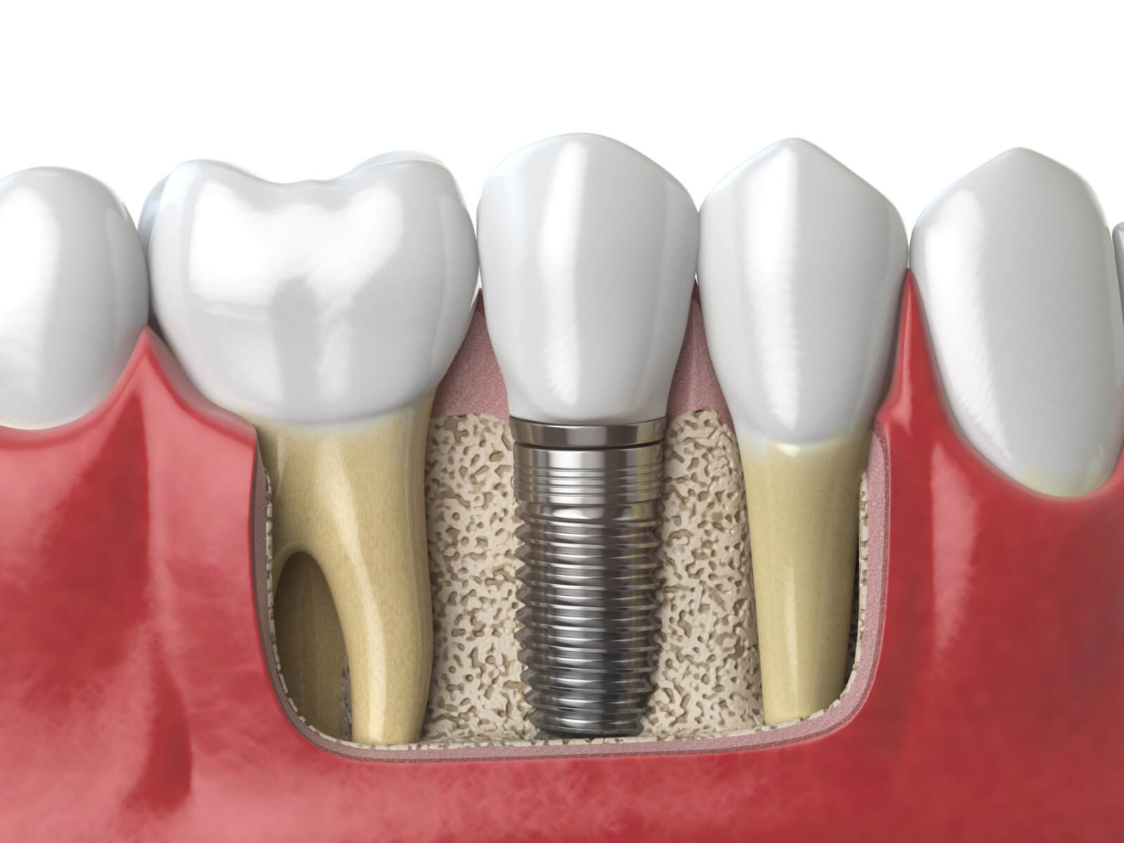 Why More Seniors Are Choosing Dental Implants Over Dentures
