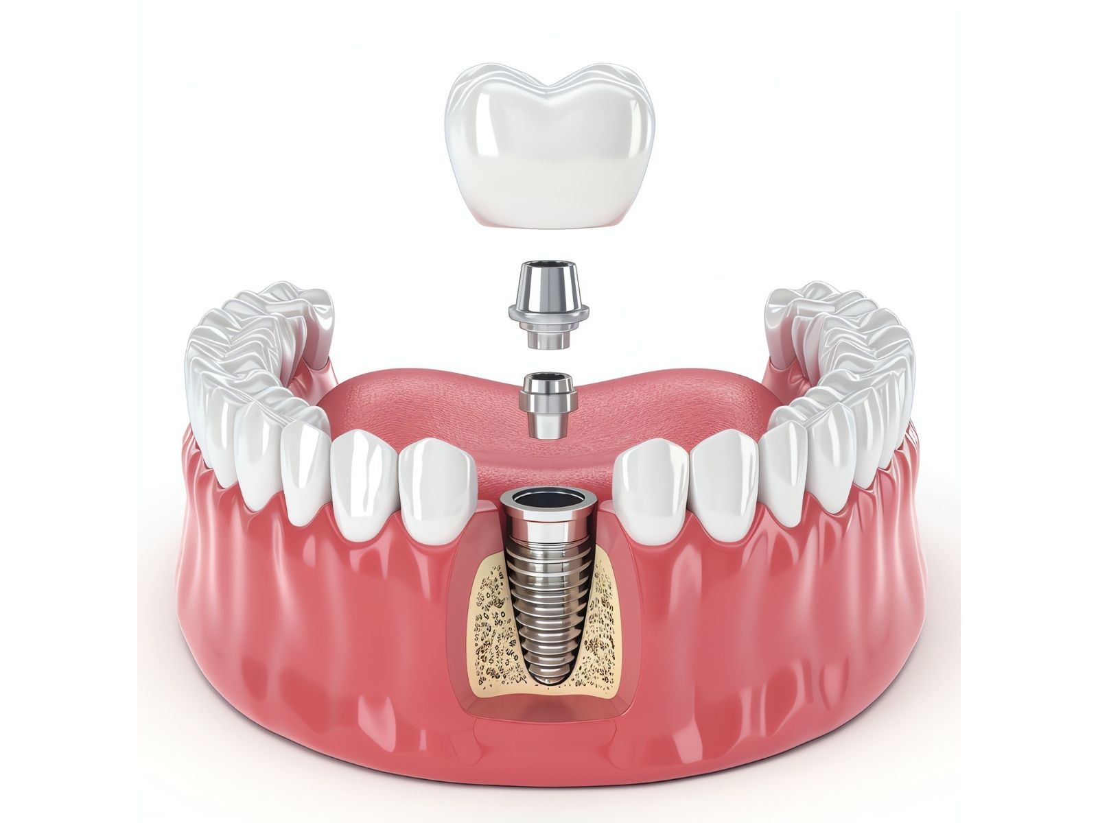 5 Different Types of Dental Implants and How to Choose the Right One