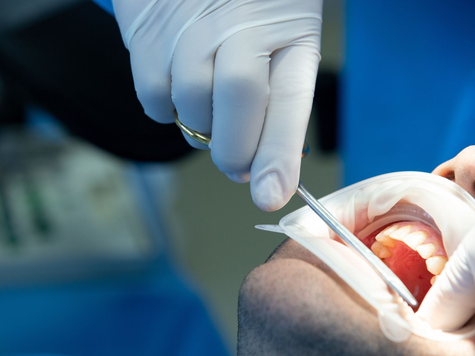 When Can You Use a Straw Again After Wisdom Tooth Removal?
