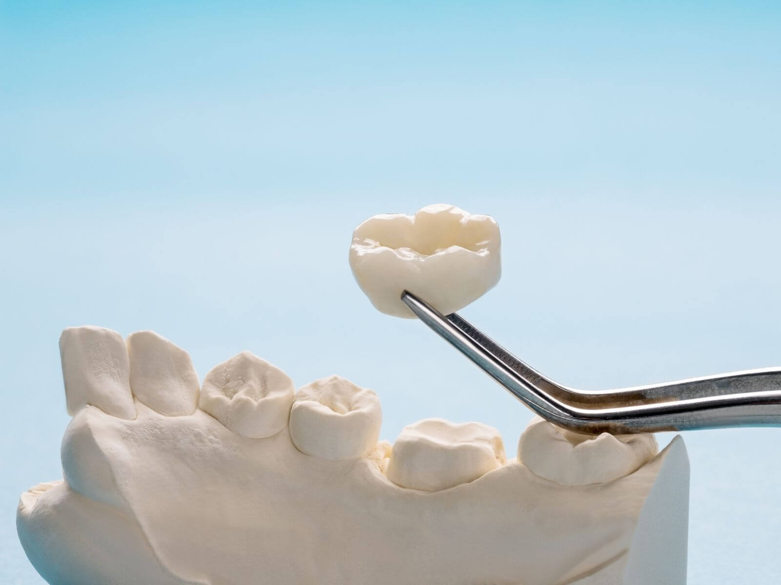 5 Different Types of Dental Implants and How to Choose the Right One – Copy