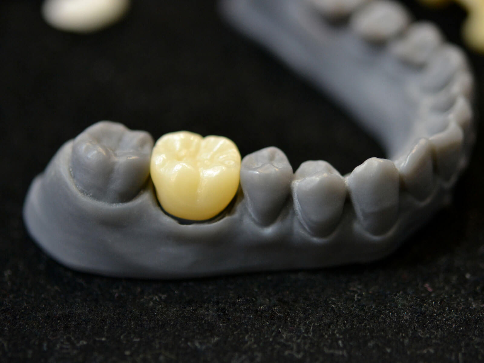 7 Signs You Need a Dental Crown